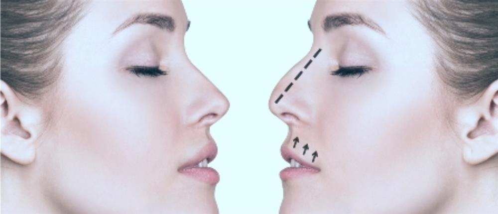 Preservation Rhinoplasty: Η πιο νέα τεχνική ρινοπλαστικής