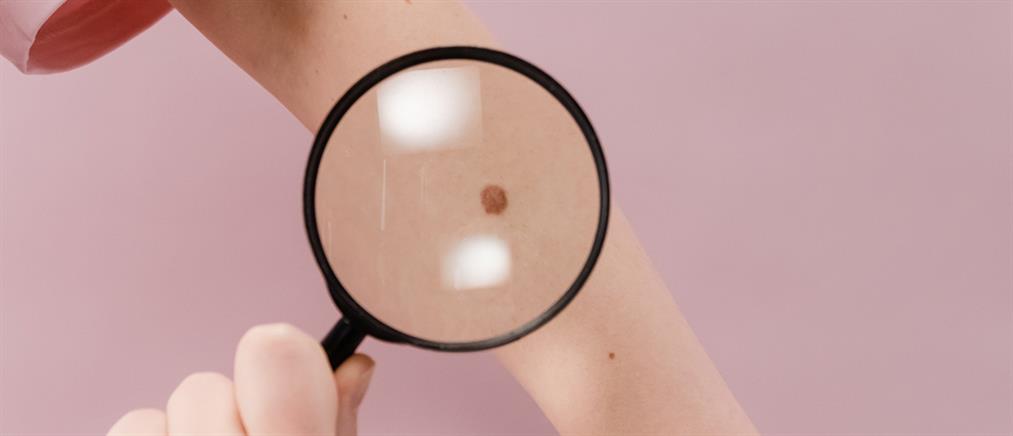 Μελάνωμα: Διάγνωση και μέτρα πρόληψης από τον καρκίνο του δέρματος