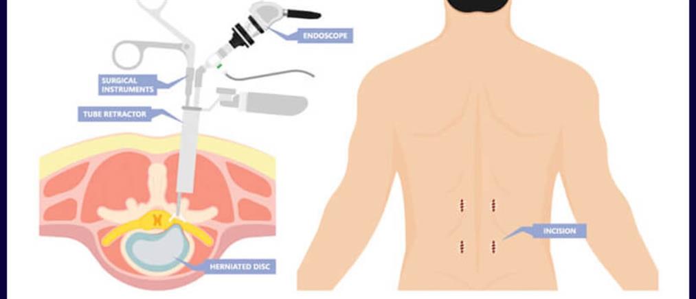Ενδοσκοπική χειρουργική σπονδυλικής στήλης