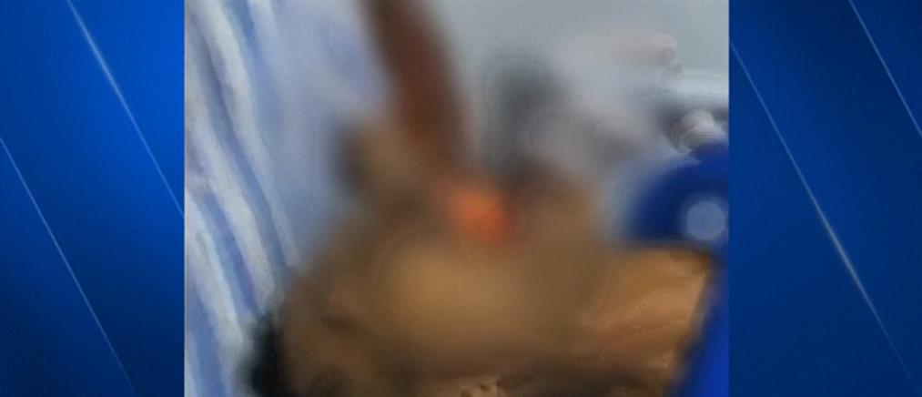 Γιατροί βγάζουν από το στόμα άνδρα ζωντανό ψάρι (βίντεο)