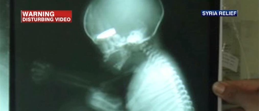 Συρία: Σοκάρει η φωτογραφία εμβρύου με σφαίρα στο κεφάλι
