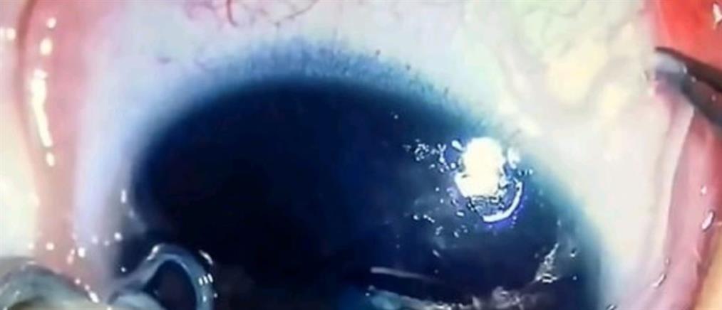 Βίντεο – σοκ: Γιατροί έβγαλαν 11 σκουλήκια από το μάτι βρέφους – Μολύνθηκε από κατοικίδιο