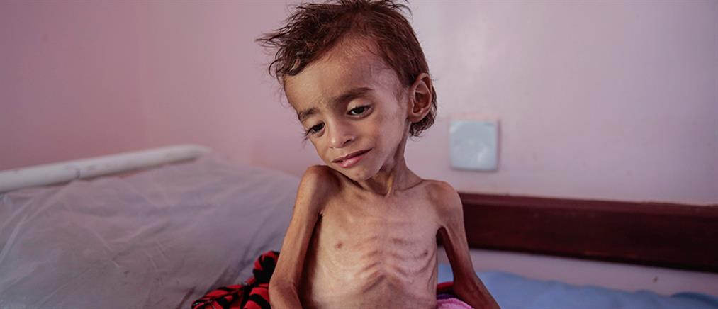 Σοκάρουν τα στοιχεία για τα παιδιά που πέθαναν από υποσιτισμό στην Υεμένη