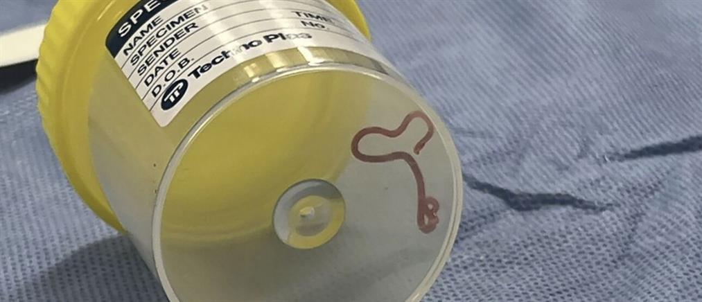 Ζωντανό σκουλήκι 8 εκατοστών βρέθηκε σε εγκέφαλο γυναίκας (εικόνες)