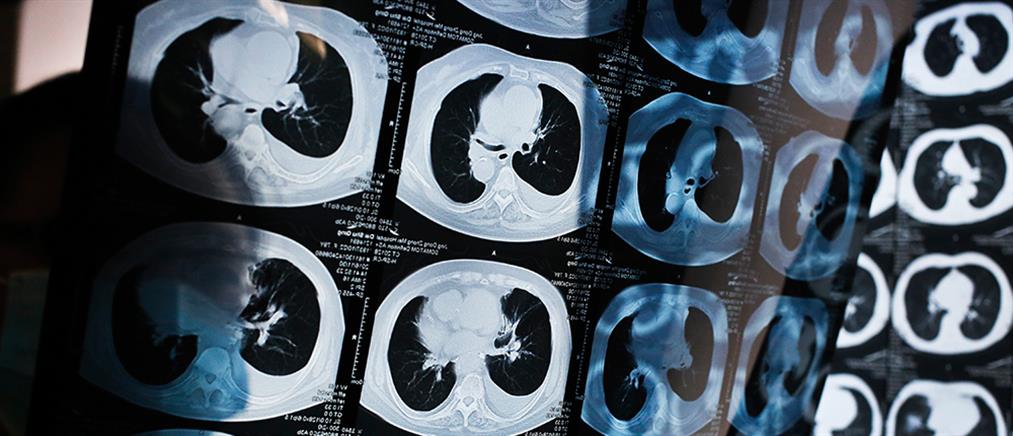 Διπλή μεταμόσχευση πνευμόνων σε καρκινοπαθή τελικού σταδίου