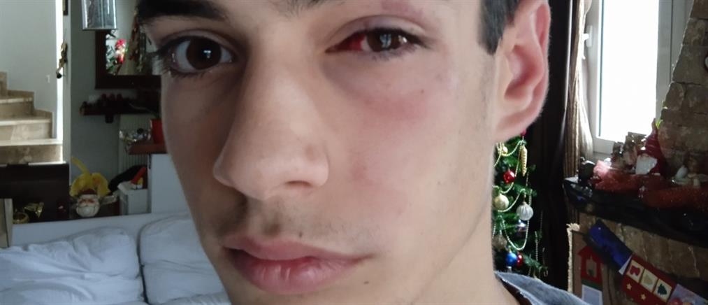 Χαλκιδική - Ξυλοδαρμός ανηλίκου: Στο νοσοκομείο ο 15χρονος