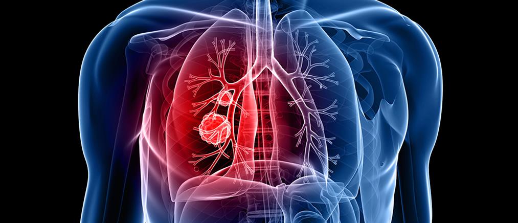 Στερεοτακτική ακτινοθεραπεία (SBRT) στον πρώιμο καρκίνο του πνεύμονα: όταν το χειρουργείο δεν είναι λύση!