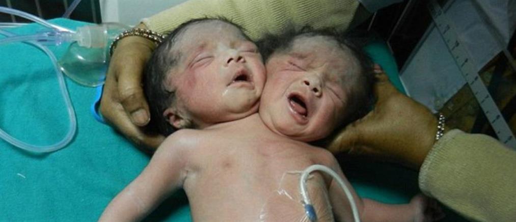 Ανατριχιαστικό: Γεννήθηκε μωρό με δύο κεφάλια!