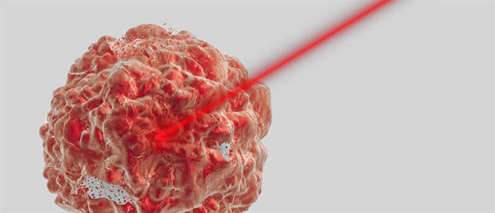 Καρκίνος του προστάτη: Νεότερα δεδομένα στην Ακτινοθεραπεία