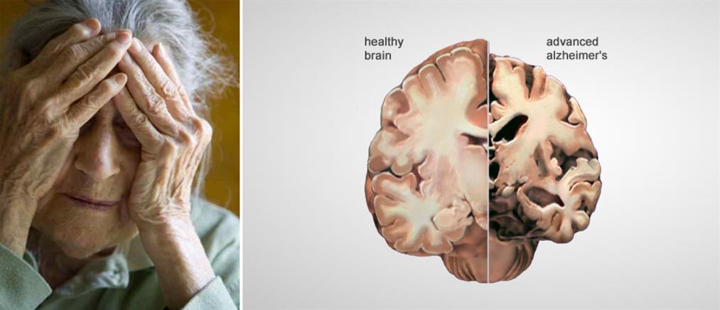 Η ατμοσφαιρική ρύπανση και η επίδραση στον εγκέφαλο των ηλικιωμένων