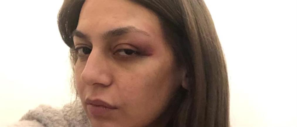 ΜέΡΑ25 - Μαρία Απατζίδη: Με χτύπησαν τα ΜΑΤ
