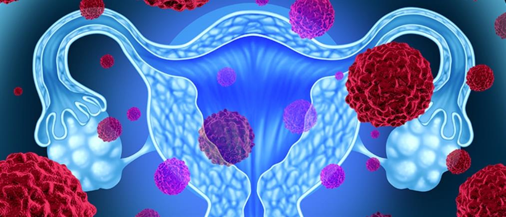 Καρκίνος του ενδομητρίου: Τα νεότερα δεδομένα για τη θεραπεία