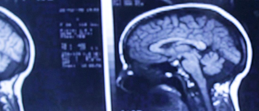 AP - μαύρη αγορά - εμφυτεύματα - εγκέφαλος - χειρουργείο - χειρουργική επέμβαση - διάβασμα σκέψης - μυαλό