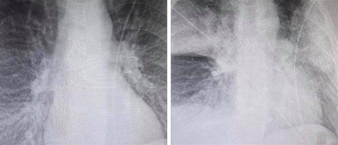 “Ακτινογραφία - σοκ: Η ραγδαία επιδείνωση 38χρονου ασθενή με κορονοϊό” 