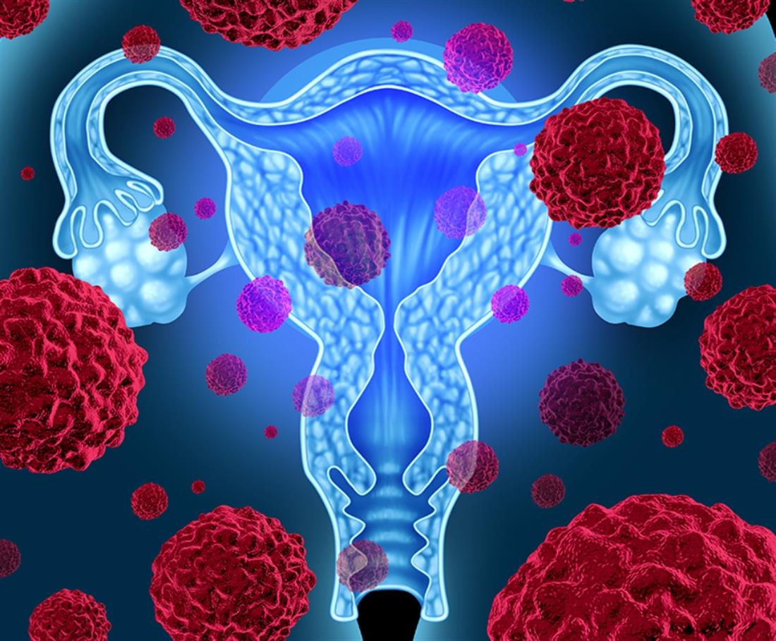 HHG - Αραβαντινού - Καρκίνος του ενδομητρίου
