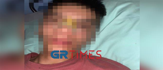 Θεσσαλονίκη: 14χρονος έπεσε θύμα άγριου ξυλοδαρμού (εικόνες)